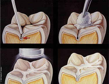 Dental Sealants