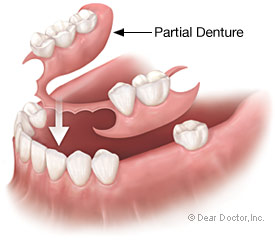 Partial Denture