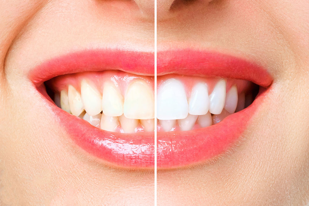 How Zoom!™ Whitening Can Transform Your Smile