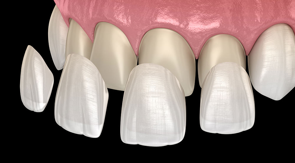 Am I a Candidate for Porcelain Veneers?
