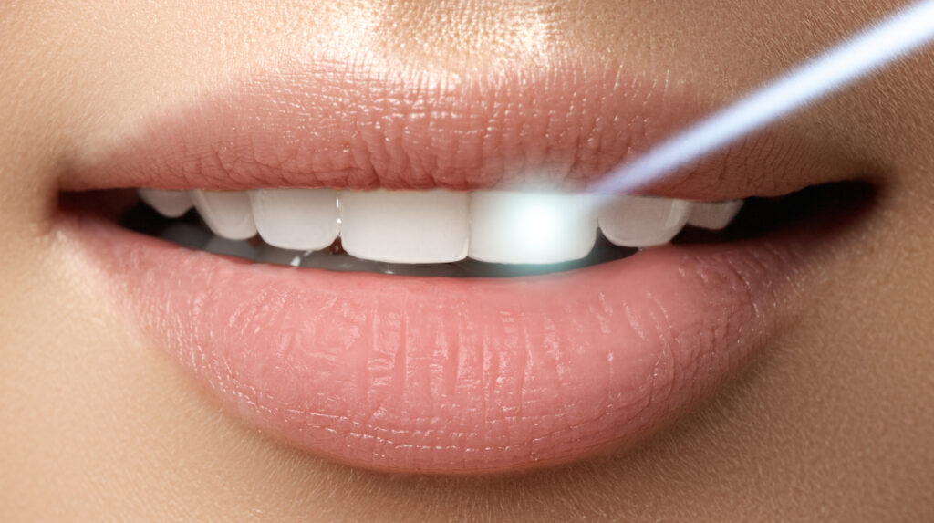 The Advantage of Using Laser Dentistry