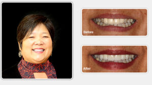 Amy A. Before and After Smile Makeovers