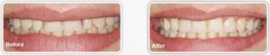 Olivia F. | Before and After Cosmetic Dental Bonding