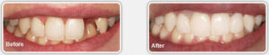 Grace H. Before and After Porcelain Crowns And Bridges
