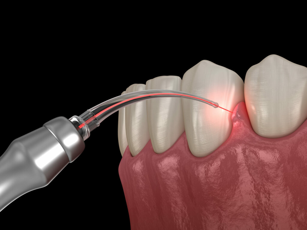Gum correction surgery with laser. Medically accurate tooth 3D illustration