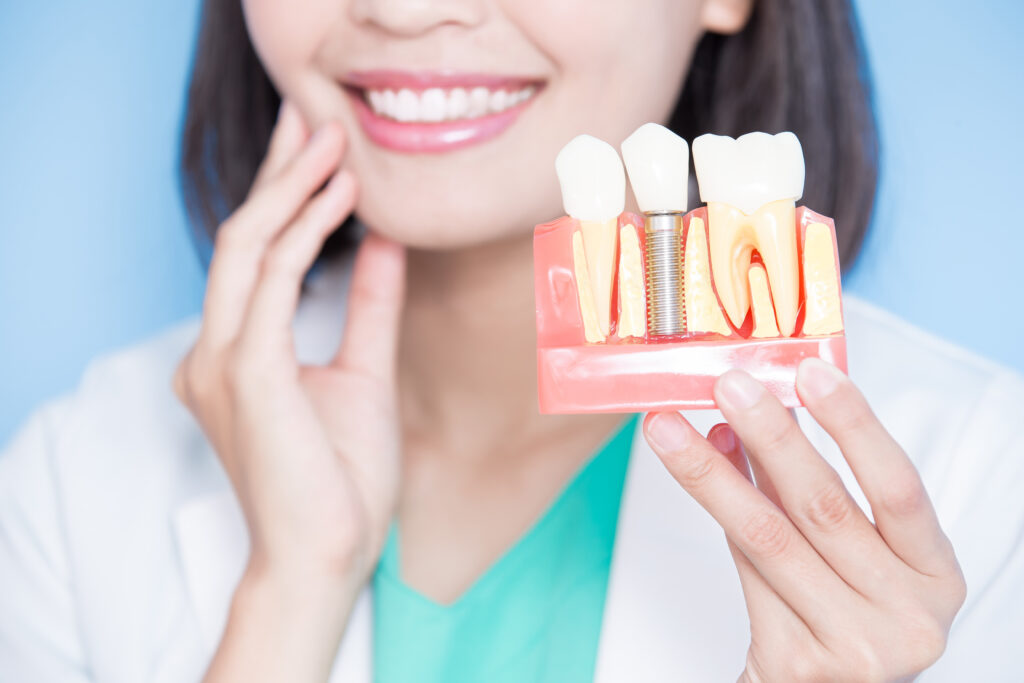 What Are the Benefits of Dental Implants?