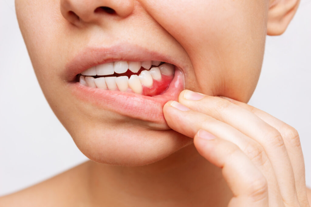 July - Is Laser Treatment Effective for Gum Disease?