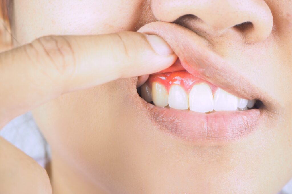 Inflammation of the gums and teeth.