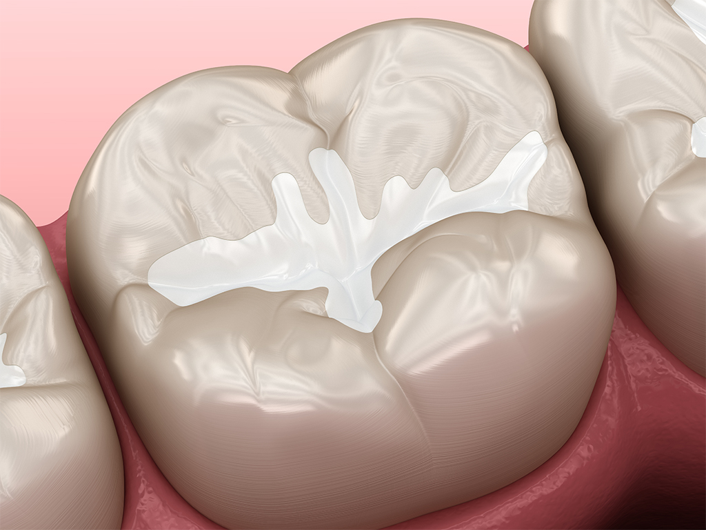 Are dental sealants only for kids